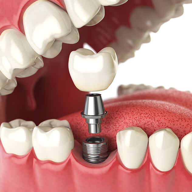 What are
dental implants?