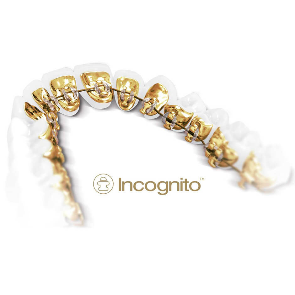 What are
lingual braces?