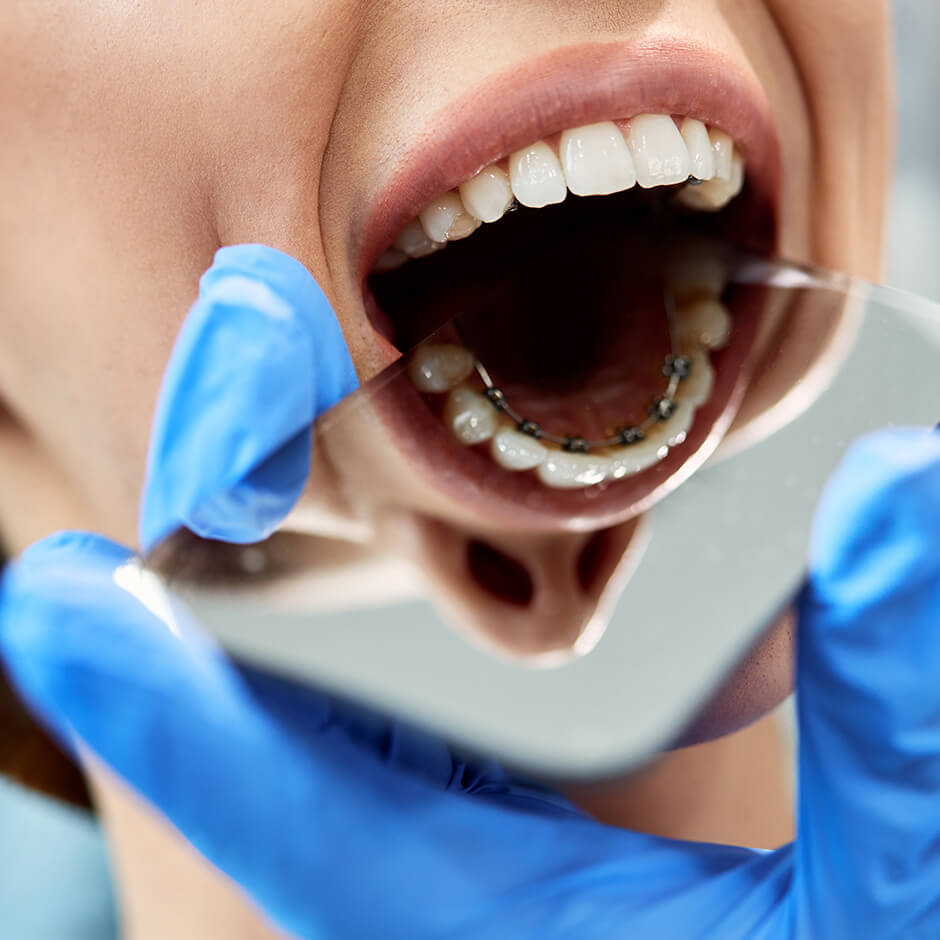 What are the benefits of lingual braces?