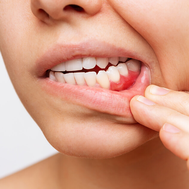 What is
gum disease?
