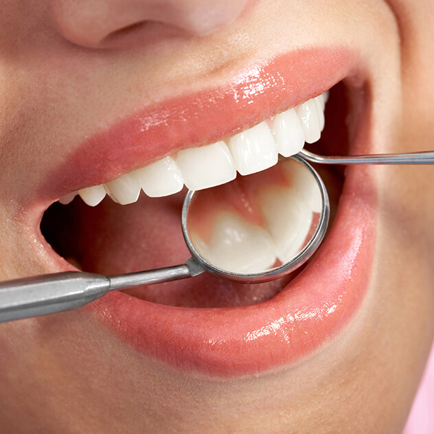 What are
white fillings?