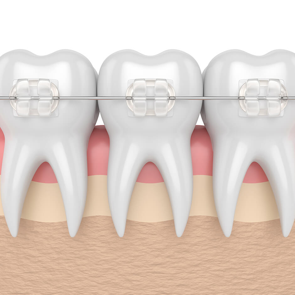 What are
ceramic braces?